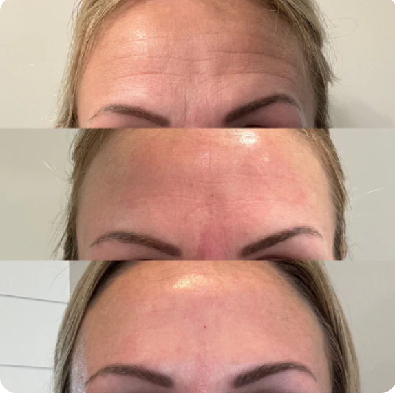 Advanced Silicone Scar Sheets