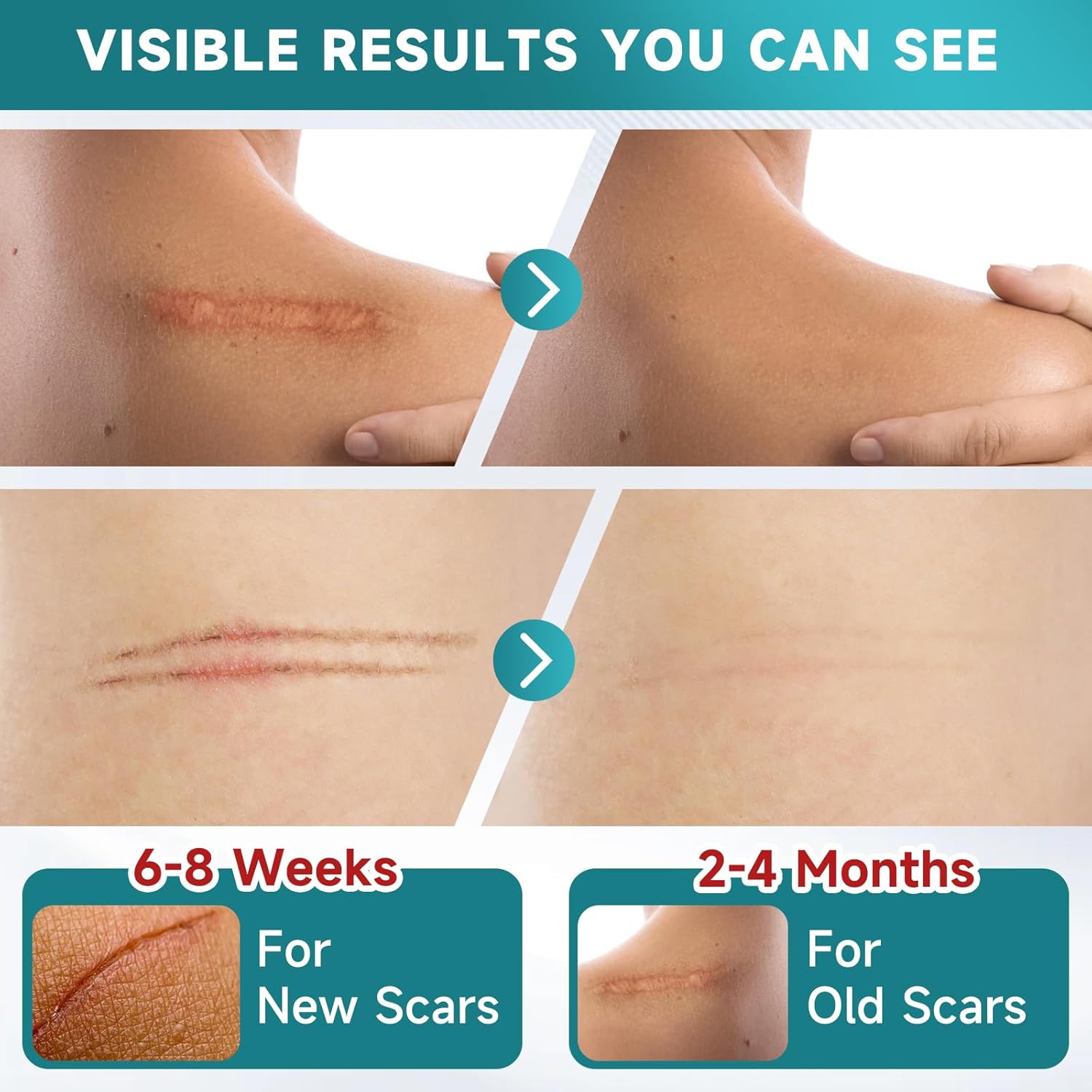 HelioMD Scar Silicone Tape